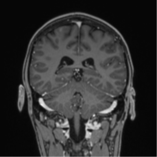 Acute disseminated encephalomyelitis (ADEM) (Radiopaedia 65319-74349 Coronal T1 C+ 11).png