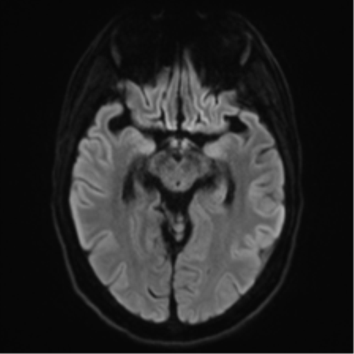 File:Acute disseminated encephalomyelitis (ADEM) (Radiopaedia 65319-74350 Axial DWI 12).png