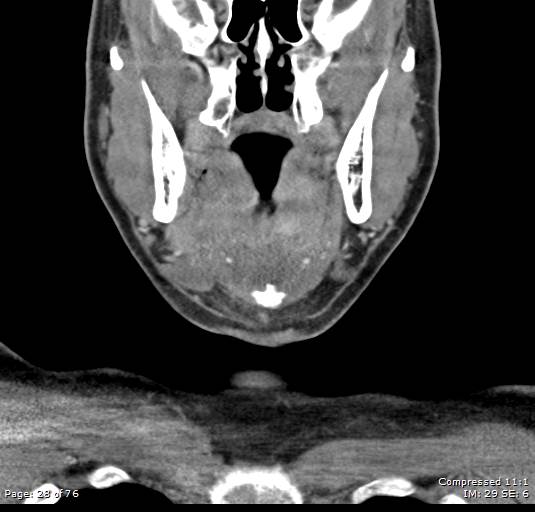 Acute epiglottitis (Radiopaedia 54375-60590 Coronal C+ arterial phase 28).jpg