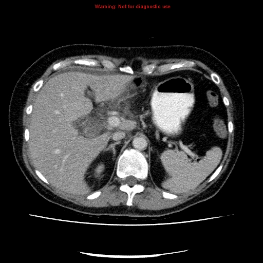 Acute gangrenous cholecystitis (Radiopaedia 10123-10661 Axial C+ portal venous phase 25).jpg