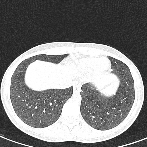 File:Acute hypersensitivity pneumonitis (Radiopaedia 85293-100870 Axial lung window 97).jpg