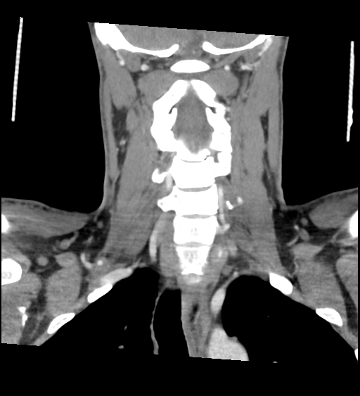 Acute longus colli calcific tendinitis (Radiopaedia 72495-83036 Coronal C+ arterial phase 44).jpg