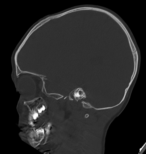 Acute mastoiditis (Radiopaedia 82678-96881 Sagittal bone window 21).jpg