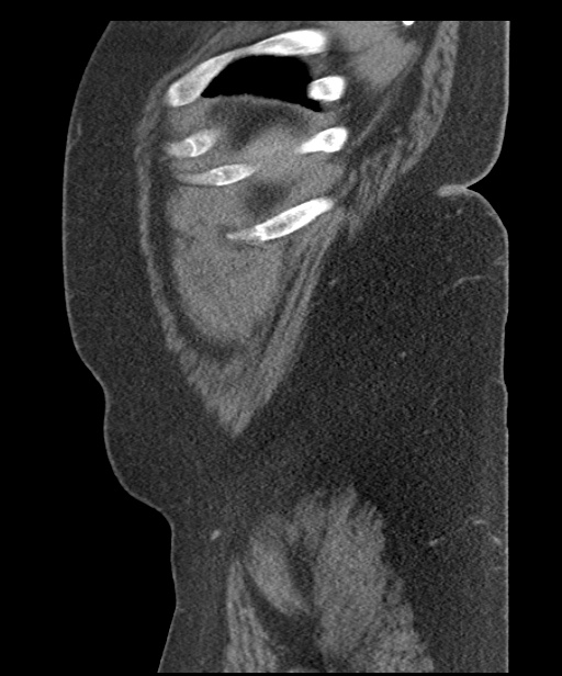 Acute mesenteric venous ischemia (Radiopaedia 46041-50383 Sagittal C+ portal venous phase 111).jpg