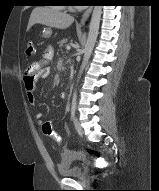 Acute mesenteric venous ischemia (Radiopaedia 46041-50383 Sagittal C+ portal venous phase 64).jpg