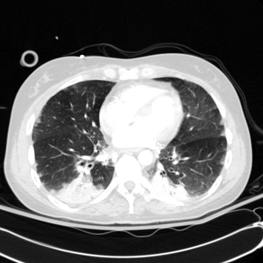 Acute myocardial infarction in CT (Radiopaedia 39947-42415 Axial lung window 83).jpg