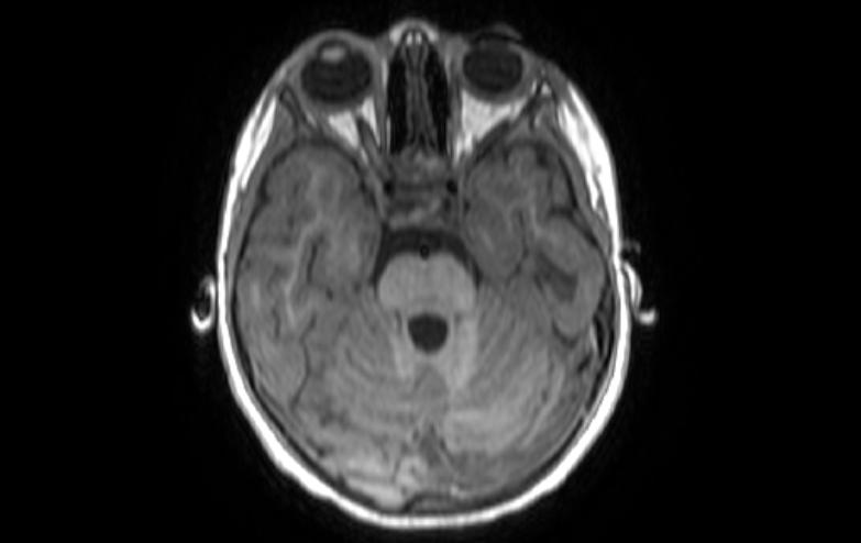 File:Acute necrotizing encephalitis of childhood (Radiopaedia 67356-76737 Axial T1 68).jpg