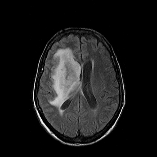 File:Acute necrotizing toxoplasma encephalitis (Radiopaedia 10683-11149 Axial FLAIR 7).jpg