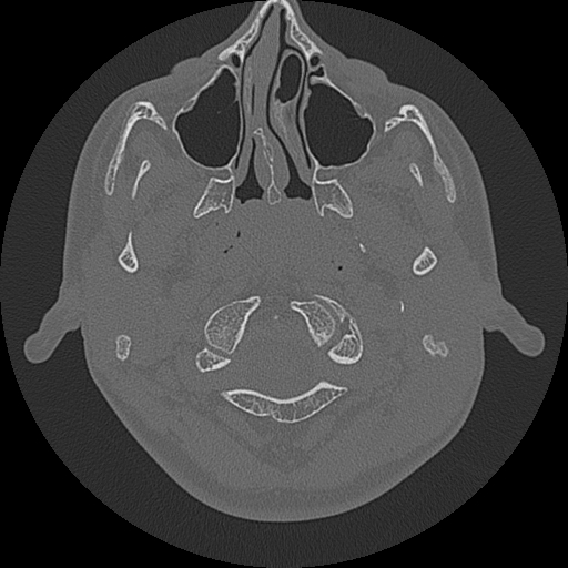 Acute otomastoiditis and Bezold abscess (Radiopaedia 88184-104786 Axial bone window 8).jpg