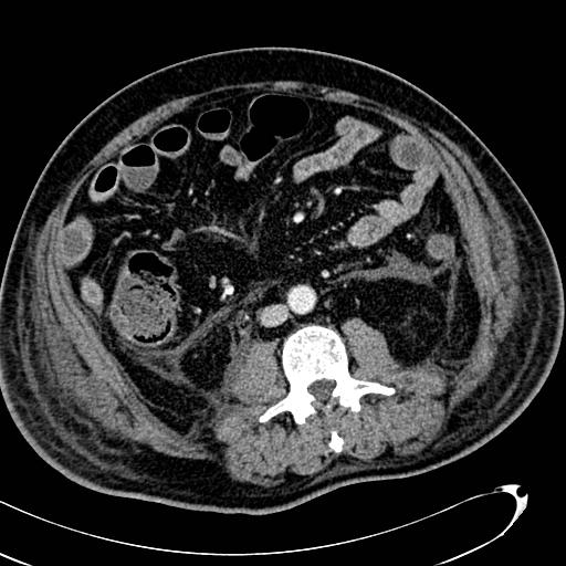 File:Acute pancreatic necrosis (Radiopaedia 13560-13486 Axial C+ portal venous phase 88).jpg