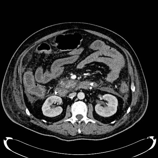 Acute pancreatic necrosis (Radiopaedia 13560-18500 Axial C+ portal venous phase 73).jpg
