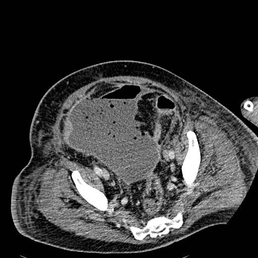 Acute pancreatic necrosis (Radiopaedia 13560-18501 Axial C+ portal venous phase 124).jpg