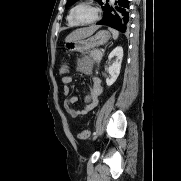 Acute pancreatitis (Radiopaedia 26663-26813 Sagittal C+ portal venous phase 51).jpg