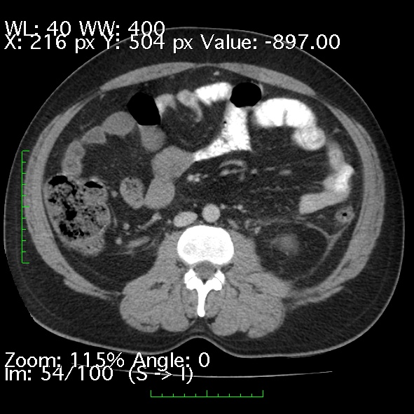 Acute pancreatitis (Radiopaedia 34043-35276 Axial C+ portal venous phase 54).jpg