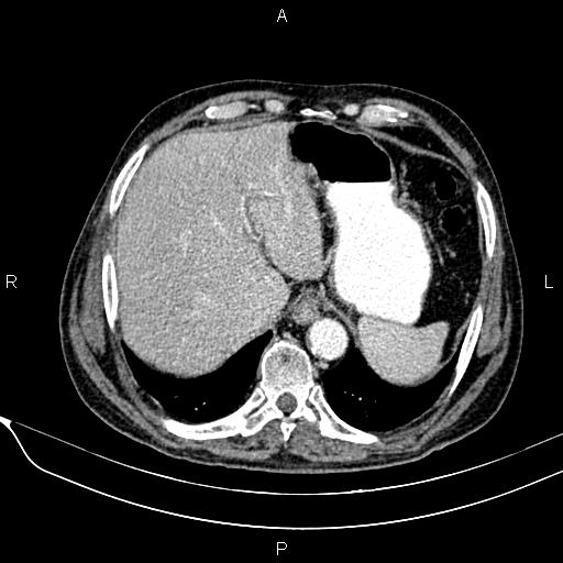 File:Acute pancreatitis (Radiopaedia 85146-100701 Axial C+ arterial phase 29).jpg
