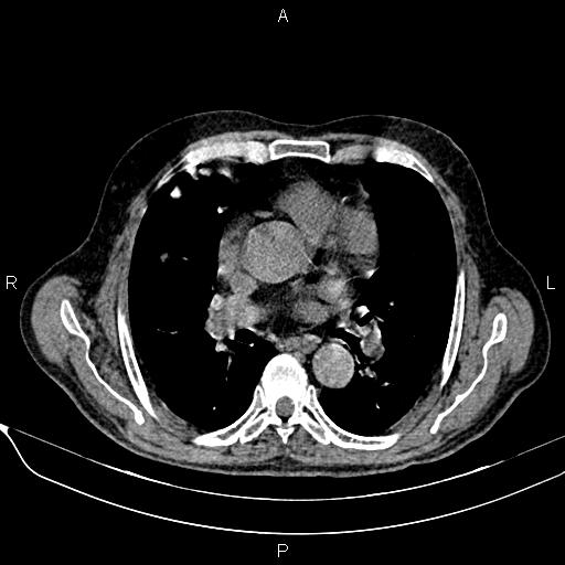 Acute pancreatitis (Radiopaedia 85146-100701 Axial non-contrast 5).jpg