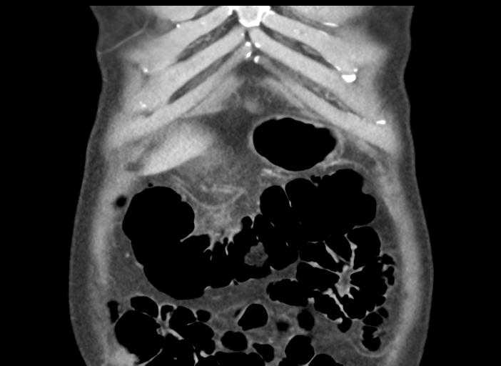 Acute pancreatitis and walled-off necrosis (Radiopaedia 29888-30404 Coronal C+ portal venous phase 9).jpg
