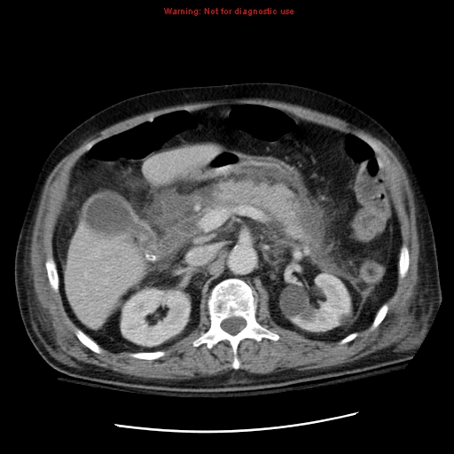 File:Acute pancreatitis with incidental pancreatic lipoma (Radiopaedia 10190-10730 Axial C+ portal venous phase 25).jpg