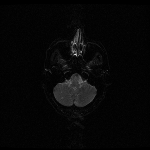 File:Acute pontine infarct from vertebral artery dissection (Radiopaedia 34111-35370 Axial Echo planar 3).png