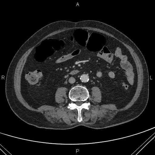 File:Acute renal artery occlusion (Radiopaedia 86586-102682 Axial C+ portal venous phase 49).jpg