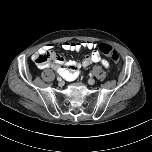 Acute renal infarction - rim capsular enhancement (Radiopaedia 59833-67270 Axial C+ portal venous phase 74).jpg