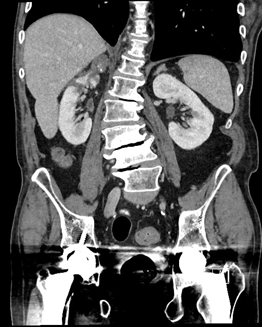 Acute renal infarction - rim capsular enhancement (Radiopaedia 59833-67270 Coronal C+ portal venous phase 37).jpg