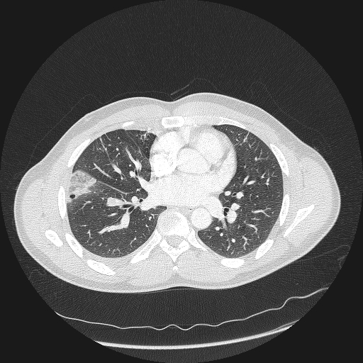 Acute segmental pulmonary emboli and pulmonary infarction (Radiopaedia 62264-70444 Axial lung window 103).jpg