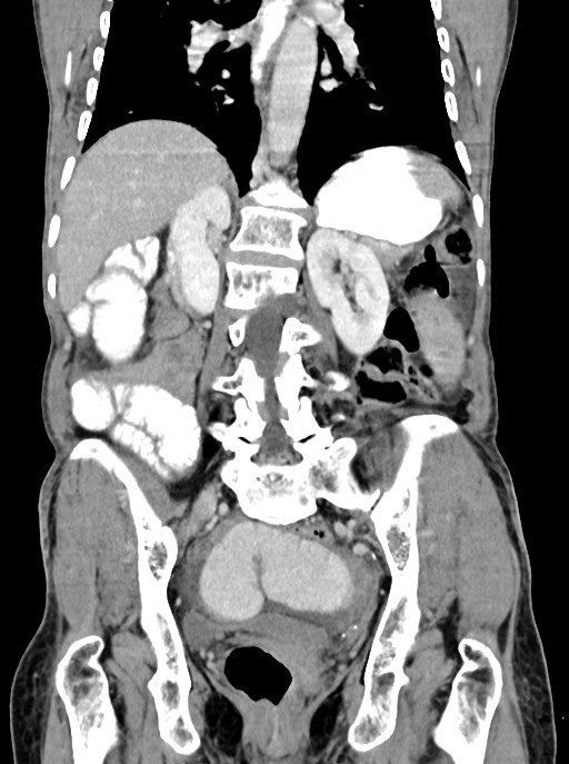 Acute small bowel (ileal) volvulus (Radiopaedia 71740-82139 Coronal C+ portal venous phase 75).jpg