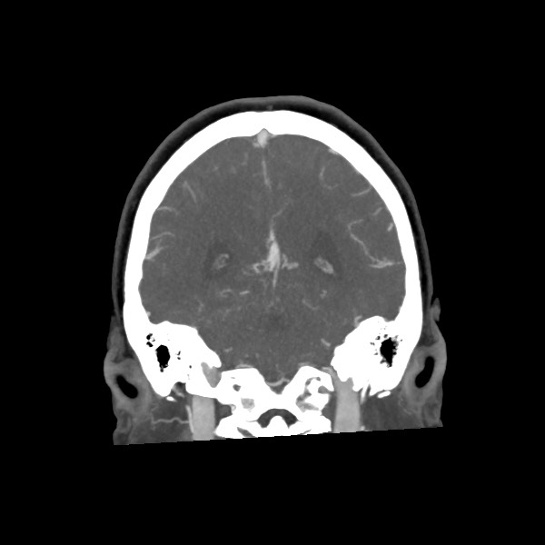 Acute subarachnoid hemorrhage and accessory anterior cerebral artery (Radiopaedia 69231-79009 Coronal C+ arterial phase 56).jpg