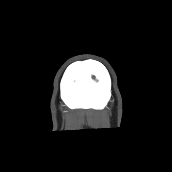 File:Acute subarachnoid hemorrhage and accessory anterior cerebral artery (Radiopaedia 69231-79009 Coronal C+ arterial phase 81).jpg