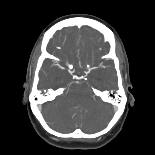Acute subarachnoid hemorrhage and accessory anterior cerebral artery (Radiopaedia 69231-79009 D 23).jpg