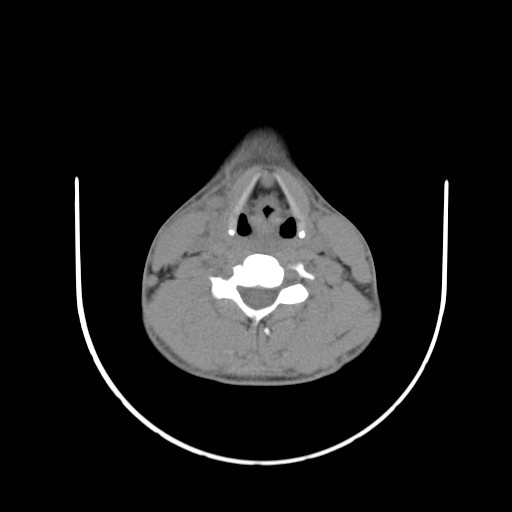 File:Acute submandibular sialadenitis secondary to ductal stone (Radiopaedia 27999-28267 Axial non-contrast 21).jpg