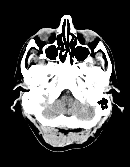 Acute superior cerebellar artery territory infarct (Radiopaedia 84104-99359 Axial non-contrast 57).jpg