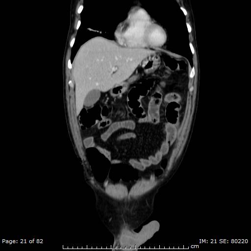 Acute superior mesenteric artery occlusion (Radiopaedia 43636-47060 Coronal C+ portal venous phase 6).jpg