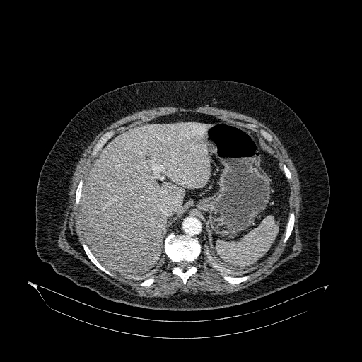 File:Acute superior mesenteric artery occlusion (Radiopaedia 51288-56960 Axial C+ arterial phase 13).jpg