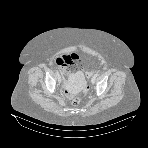File:Acute superior mesenteric artery occlusion (Radiopaedia 51288-56960 Axial lung window 67).jpg