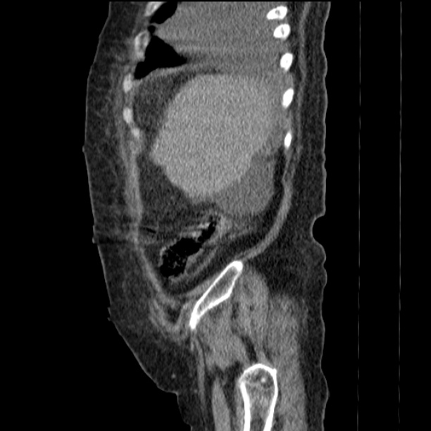 Acute tubular necrosis (Radiopaedia 28077-28334 Sagittal non-contrast 17).jpg