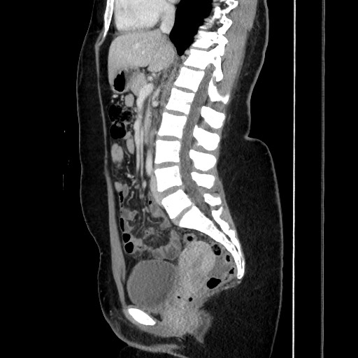 Acute uncomplicated appendicitis (Radiopaedia 73704-84499 Sagittal C+ portal venous phase 113).jpg