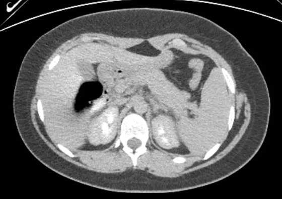Acute unilateral nonhemorrhagic adrenal infarction (Radiopaedia 67560-76957 Axial renal excretory phase 32).jpg