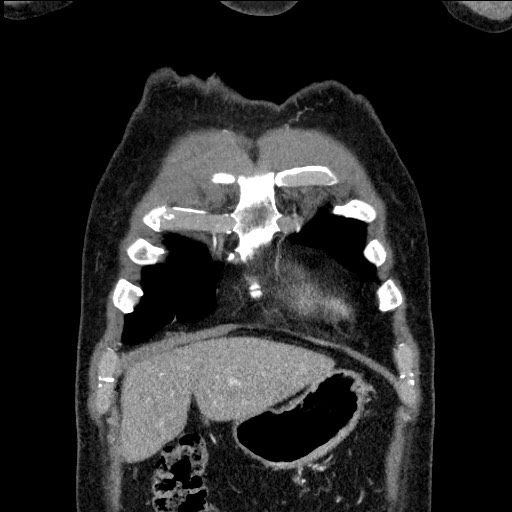 Adenocarcinoma of the lung (Radiopaedia 59871-67325 Coronal C+ arterial phase 7).jpg
