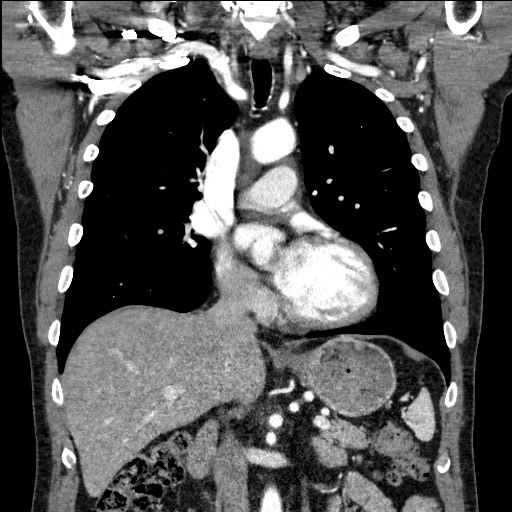 Adenocarcinoma of the lung (Radiopaedia 59871-67325 Sagittal C+ arterial phase 67).jpg