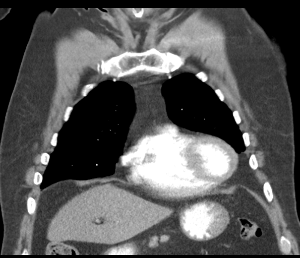 Adenocarcioma of rectum- T1 lesion (Radiopaedia 36921-38547 Coronal C+ arterial phase 20).png