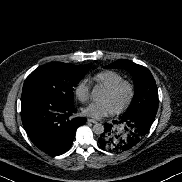 File:Adenoid cystic carcinoma of the trachea (Radiopaedia 49042-54137 Axial non-contrast 208).jpg