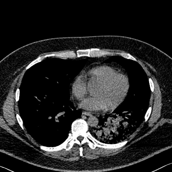 Adenoid cystic carcinoma of the trachea (Radiopaedia 49042-54137 Axial non-contrast 217).jpg