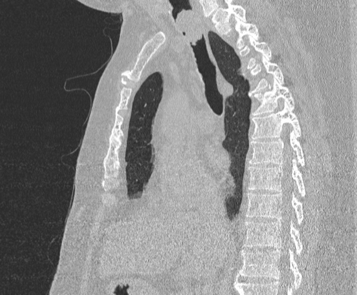 File:Adenoid cystic carcinoma of the trachea (Radiopaedia 49042-54137 Sagittal lung window 221).jpg