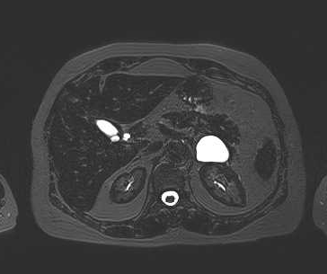 File:Adenomyomatosis of the gallbladder (Radiopaedia 50246-55587 Axial 65).png