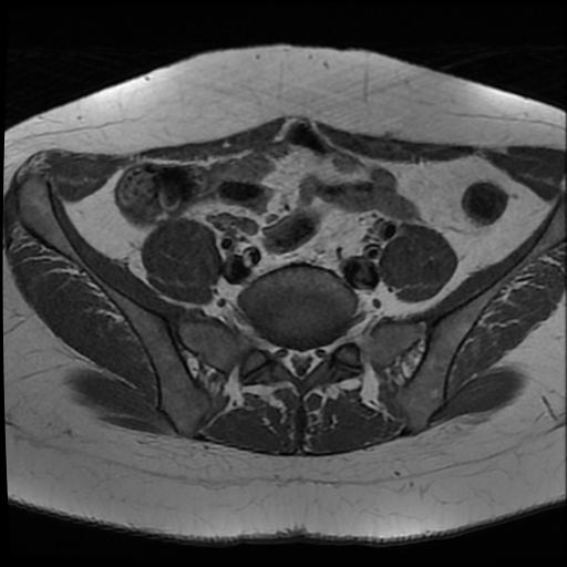 File:Adenomyosis-scar endometriosis (Radiopaedia 65863-75022 Axial T1 4).jpg