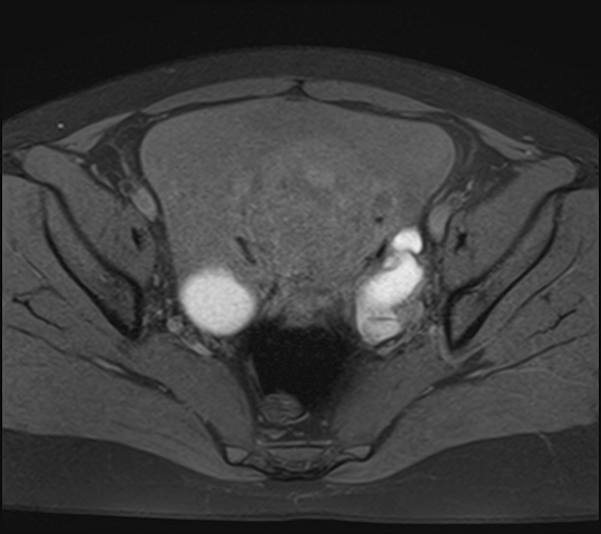 File:Adenomyosis - ovarian endometriomas (Radiopaedia 67031-76350 Axial T1 fat sat 15).jpg