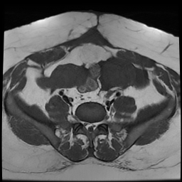 File:Adenomyosis within a didelphys uterus (Radiopaedia 70175-80215 Axial T1 16).jpg