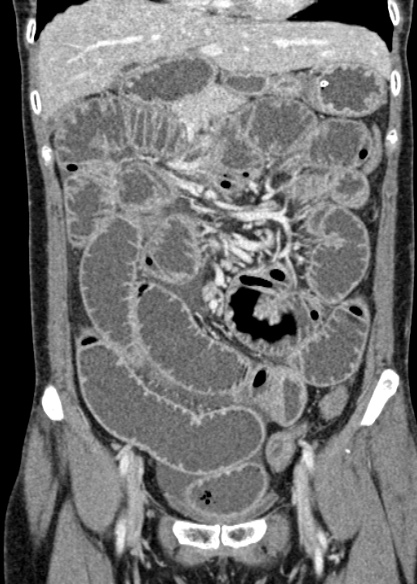 Adhesional small bowel obstruction (Radiopaedia 48397-53305 Coronal C+ portal venous phase 130).jpg